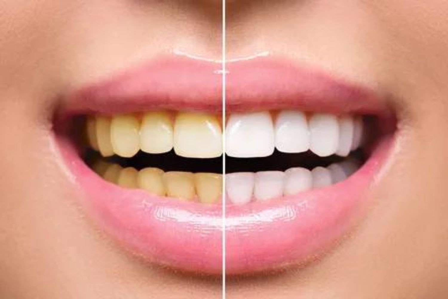 Dental Services- Teeth Whitening